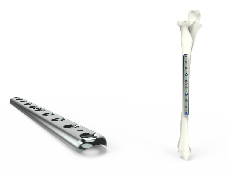 1/3 Tubular Radius Ulna Plates – TST