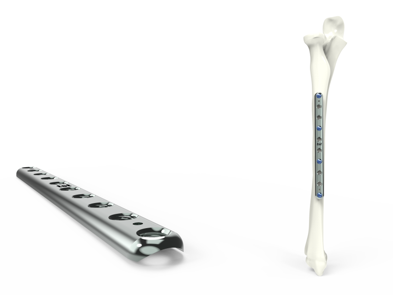 1/3 Tubular Radius Ulna Plates – TST