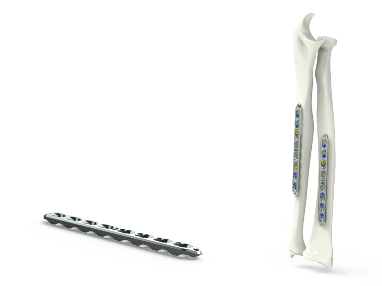 Ulna & Radius Diaphysis Plates – TST